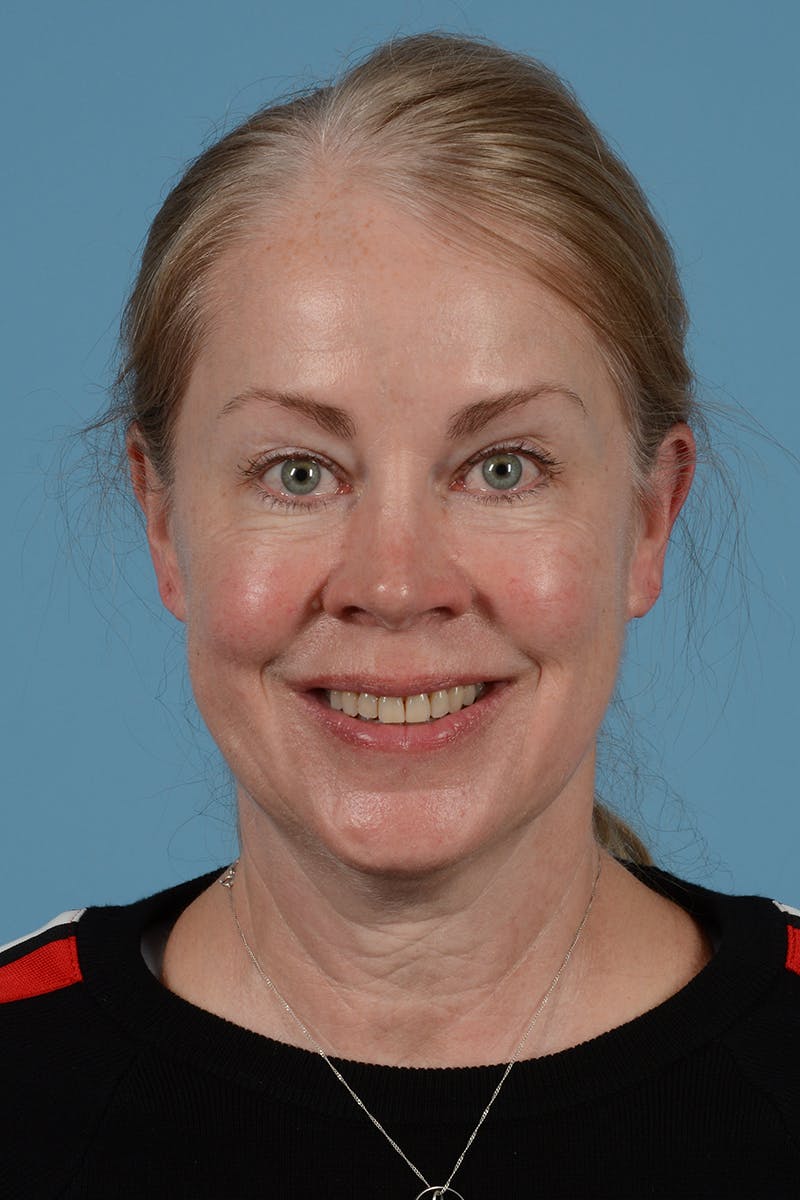 Facelift Before & After Gallery - Patient 975145 - Image 3