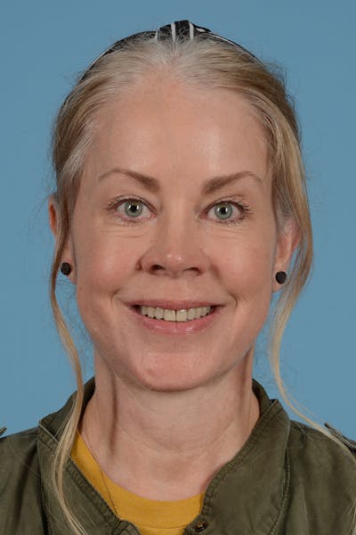 Facelift Before & After Gallery - Patient 975145 - Image 4