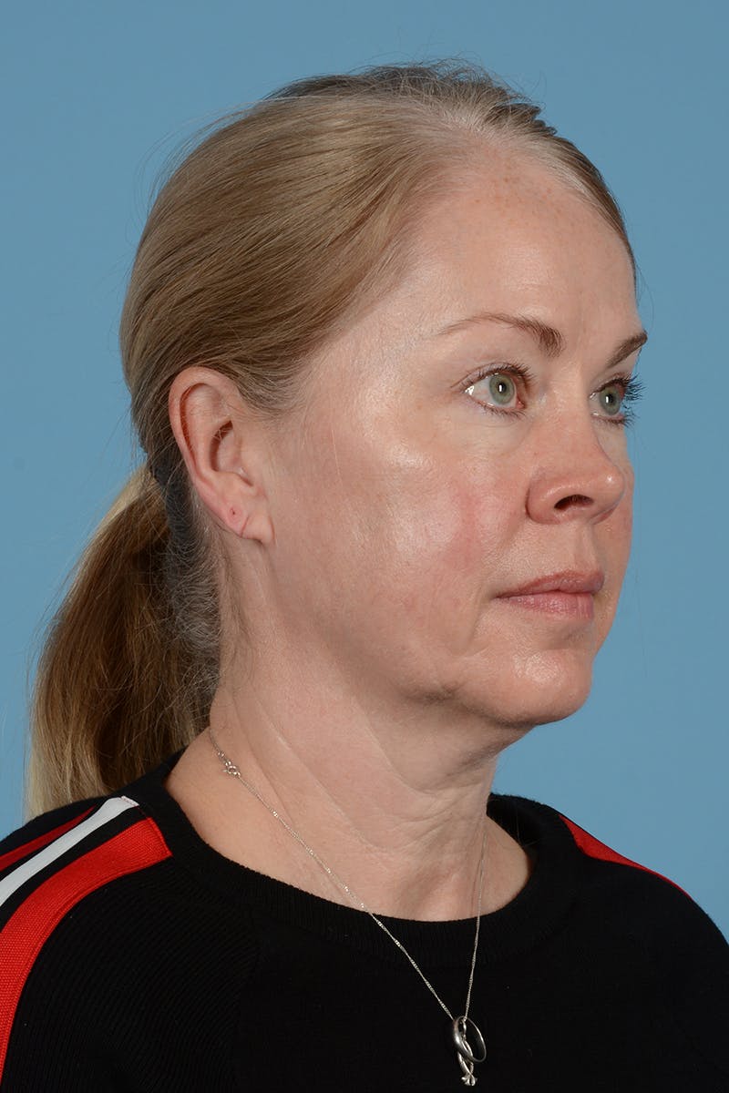 Facelift Before & After Gallery - Patient 975145 - Image 5