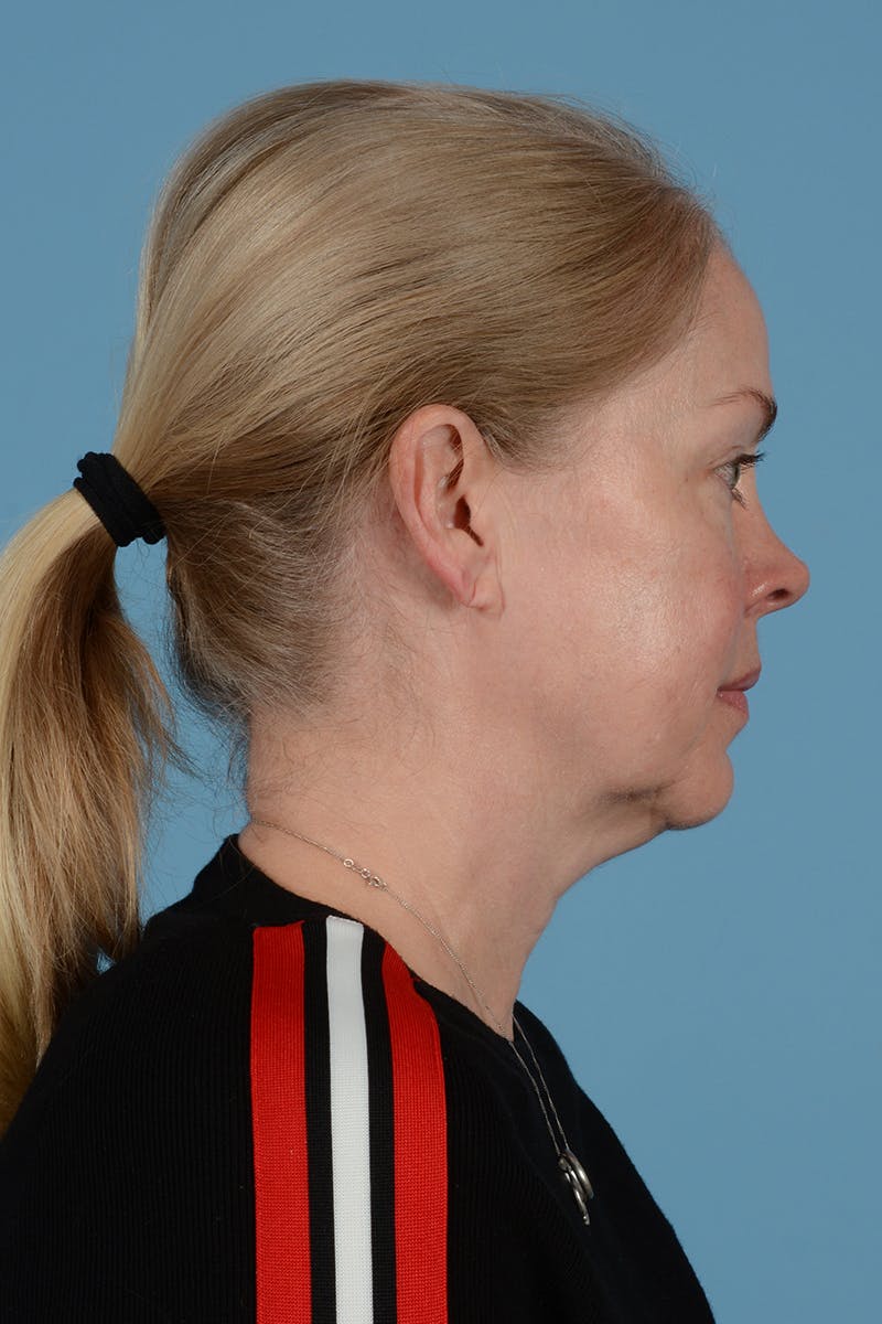 Facelift Before & After Gallery - Patient 975145 - Image 7
