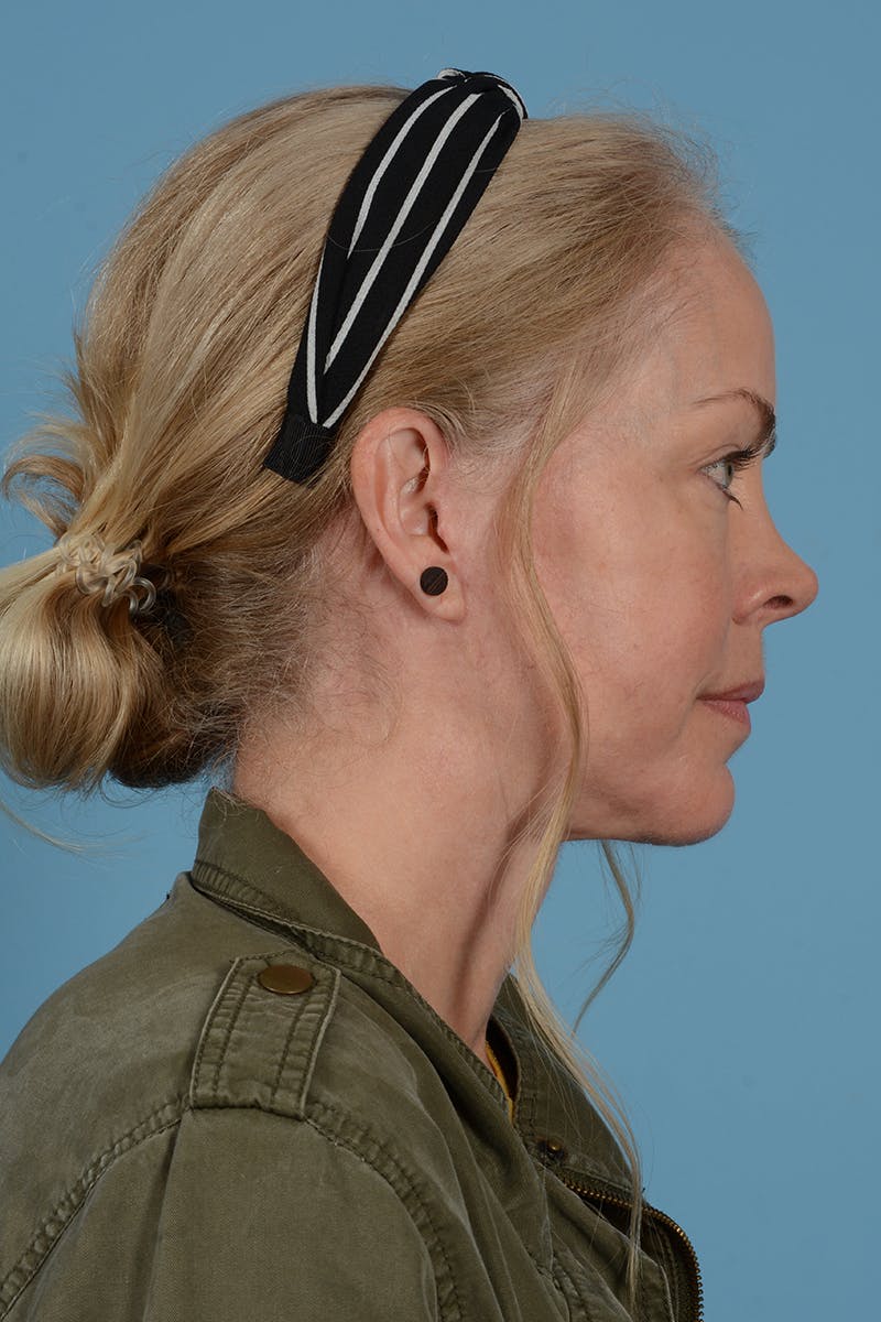 Facelift Before & After Gallery - Patient 975145 - Image 8