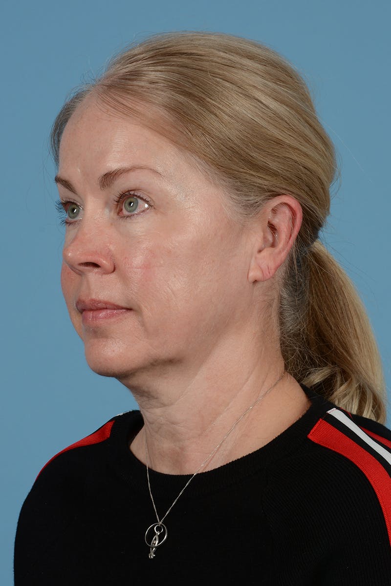 Facelift Before & After Gallery - Patient 975145 - Image 9