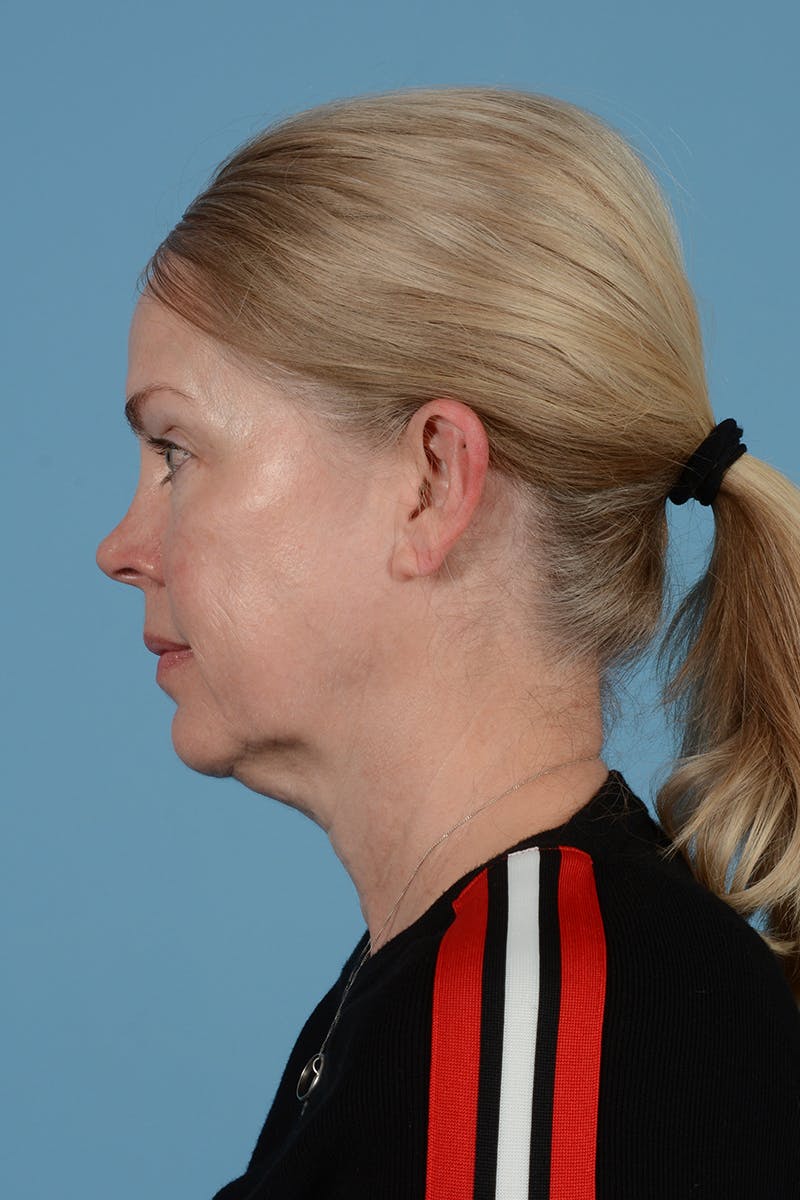 Facelift Before & After Gallery - Patient 975145 - Image 11