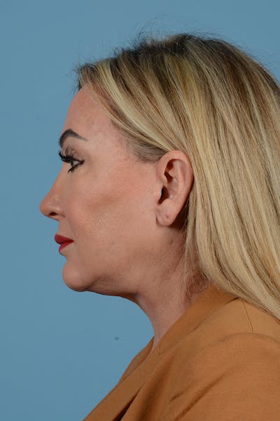 Facelift Before & After Gallery - Patient 270445 - Image 4