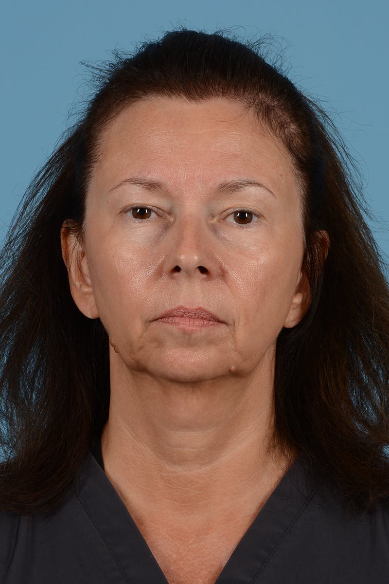 Facelift Before & After Gallery - Patient 363688 - Image 1