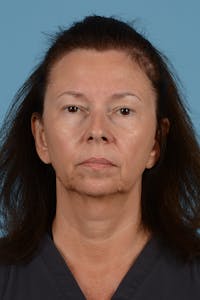Facelift Before & After Gallery - Patient 363688 - Image 1