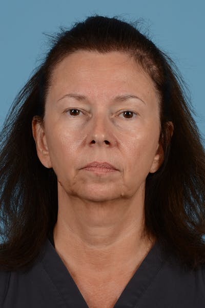 Facelift Before & After Gallery - Patient 363688 - Image 1