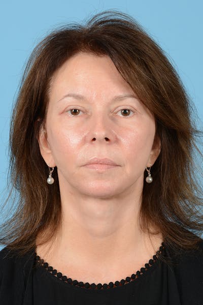 Facelift Before & After Gallery - Patient 363688 - Image 2