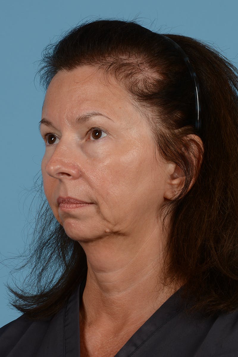 Facelift Before & After Gallery - Patient 363688 - Image 3