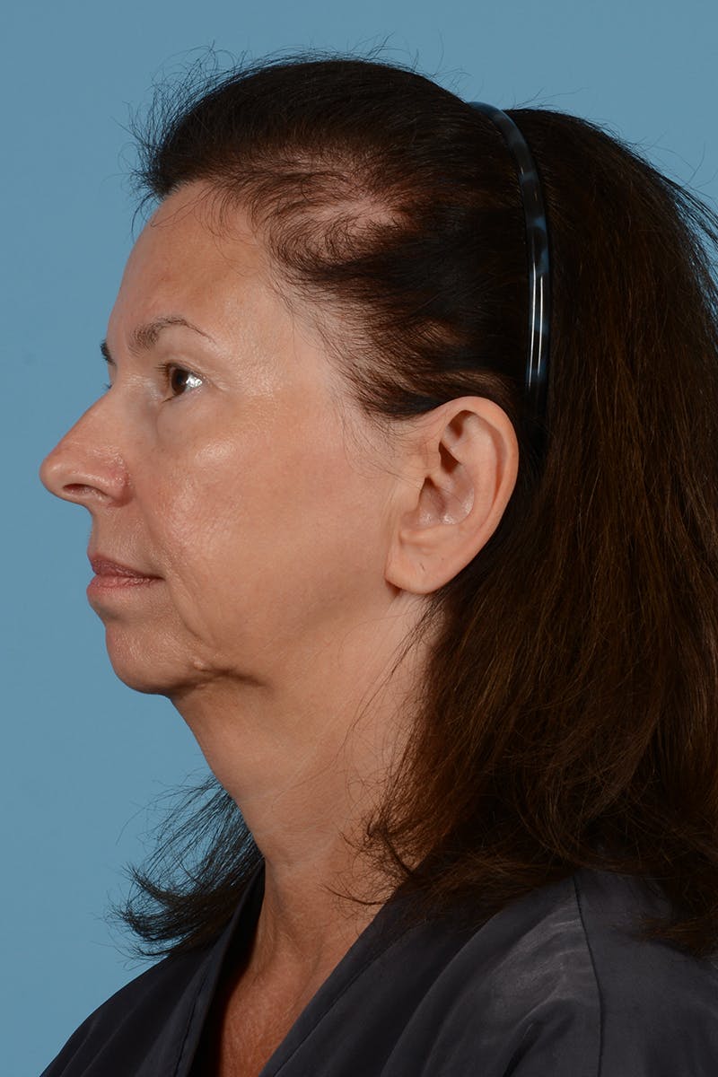 Facelift Before & After Gallery - Patient 363688 - Image 5
