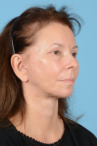 Facelift Before & After Gallery - Patient 363688 - Image 8