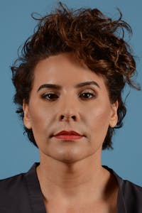 Facelift Before & After Gallery - Patient 417839 - Image 1