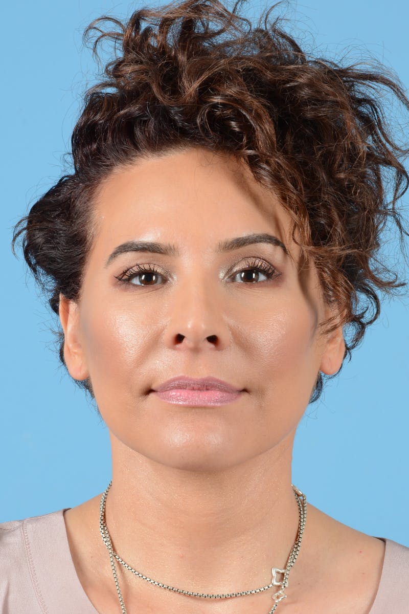 Facelift Before & After Gallery - Patient 417839 - Image 2