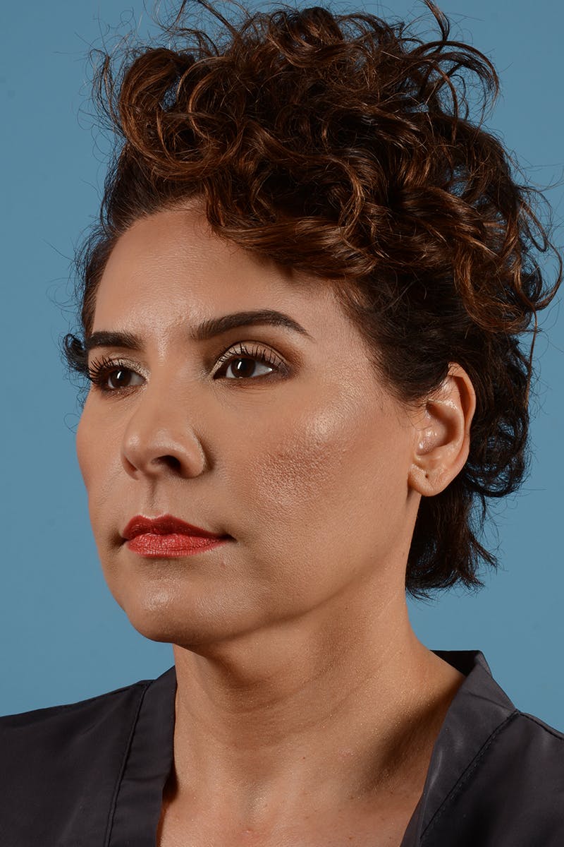 Facelift Before & After Gallery - Patient 417839 - Image 3