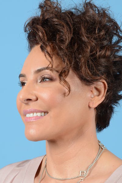 Facelift Before & After Gallery - Patient 417839 - Image 4