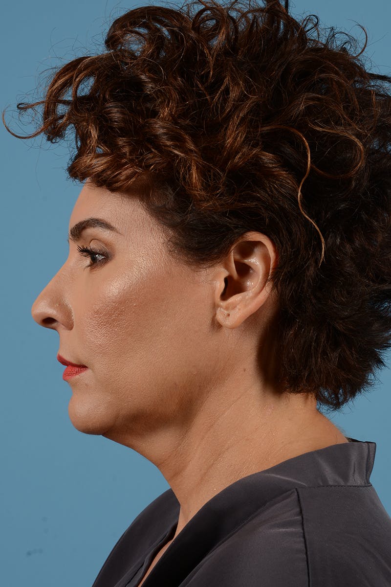 Facelift Before & After Gallery - Patient 417839 - Image 5