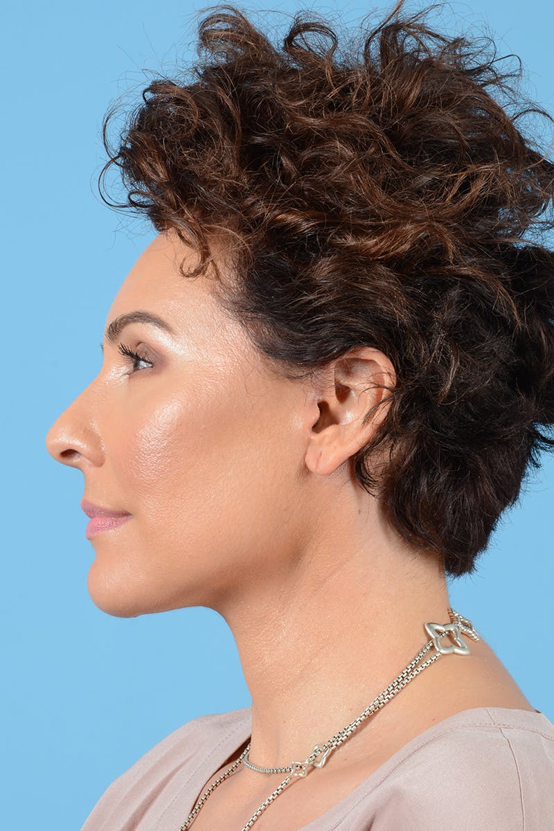 Facelift Before & After Gallery - Patient 417839 - Image 6
