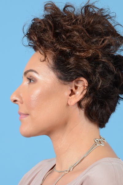 Facelift Before & After Gallery - Patient 417839 - Image 6