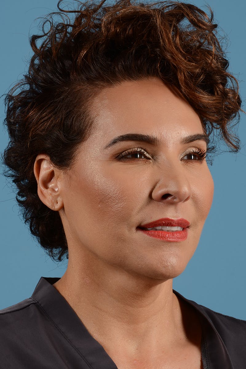 Facelift Before & After Gallery - Patient 417839 - Image 7