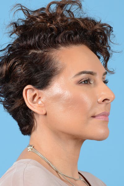 Facelift Before & After Gallery - Patient 417839 - Image 8