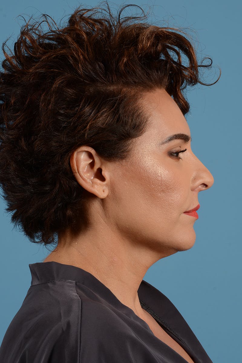 Facelift Before & After Gallery - Patient 417839 - Image 9