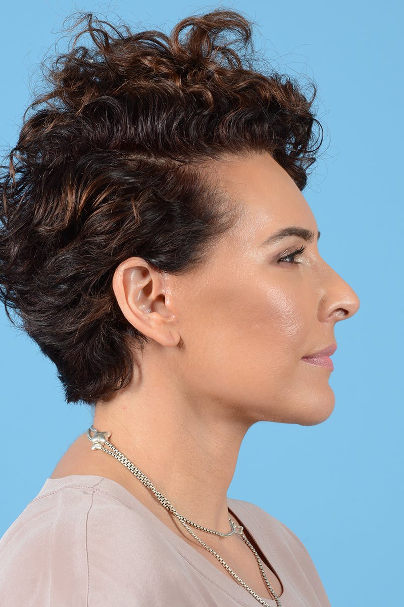 Facelift Before & After Gallery - Patient 417839 - Image 10