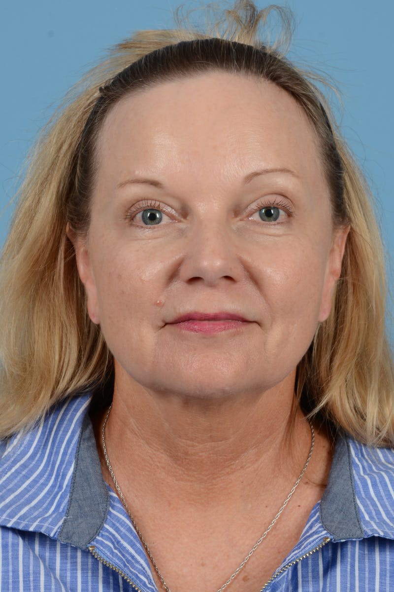 Facelift Before & After Gallery - Patient 210344 - Image 1