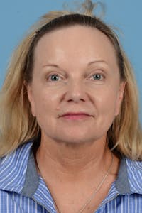 Facelift Before & After Gallery - Patient 210344 - Image 1