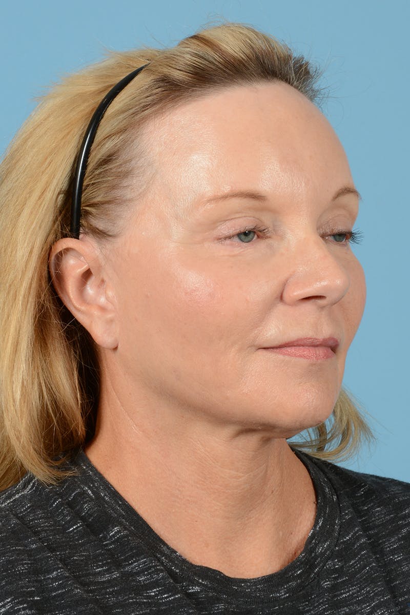 Facelift Before & After Gallery - Patient 210344 - Image 4