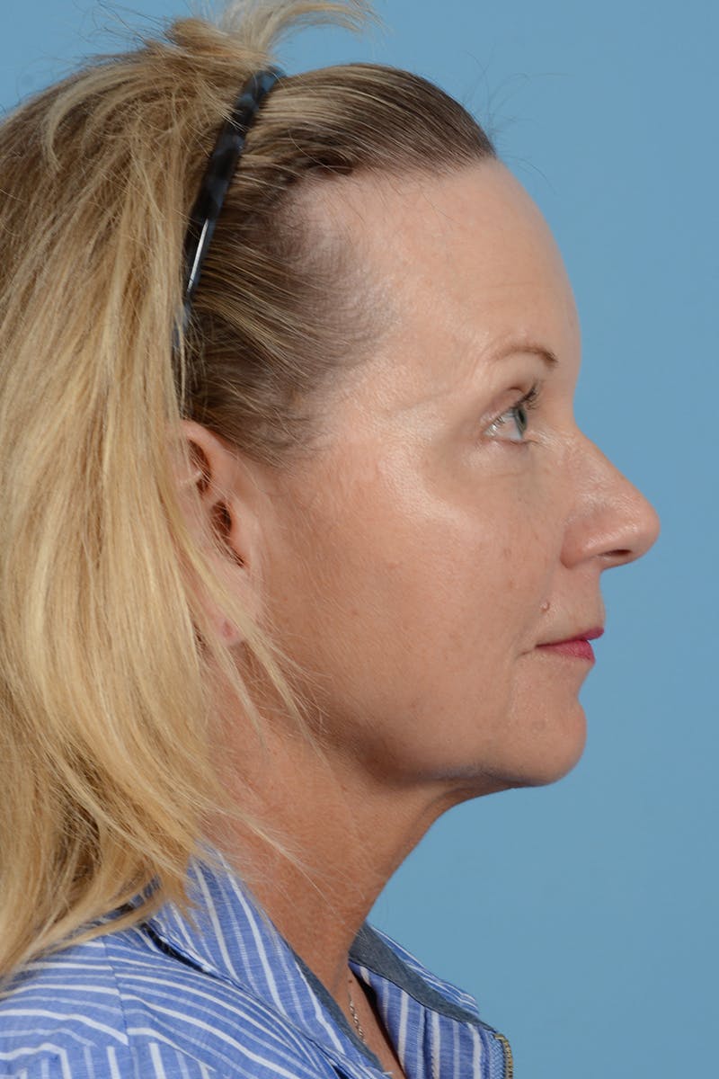 Facelift Before & After Gallery - Patient 210344 - Image 5