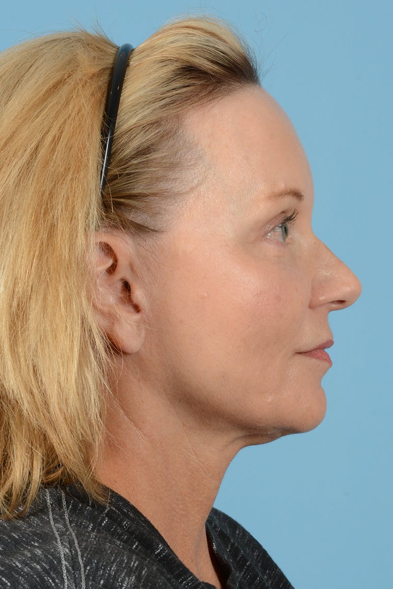 Facelift Before & After Gallery - Patient 210344 - Image 6