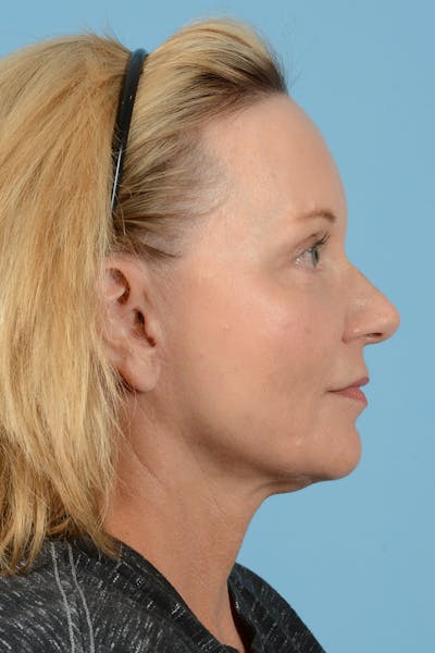 Facelift Before & After Gallery - Patient 210344 - Image 6