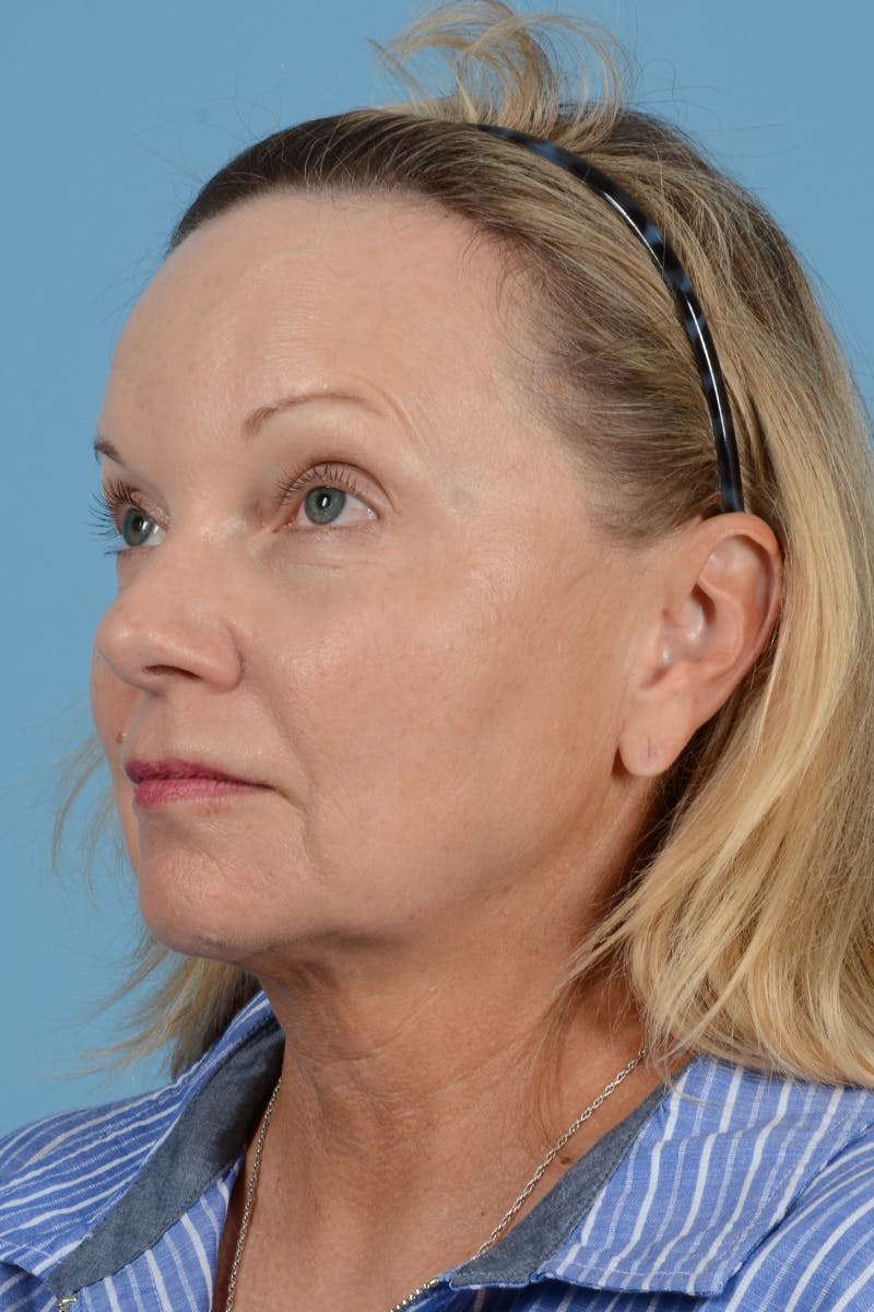 Facelift Before & After Gallery - Patient 210344 - Image 7