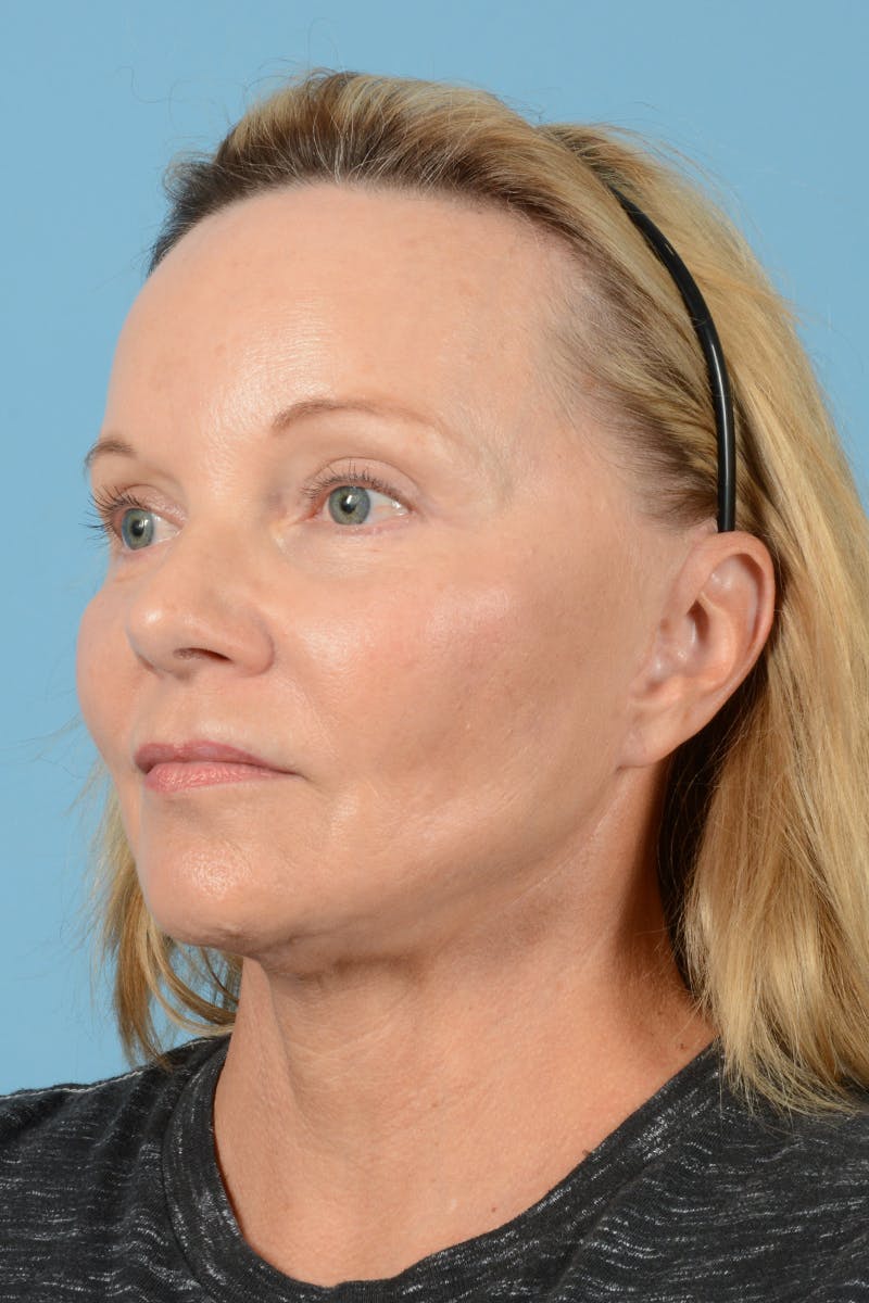 Facelift Before & After Gallery - Patient 210344 - Image 8