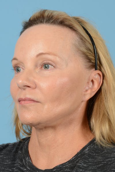 Facelift Before & After Gallery - Patient 210344 - Image 8