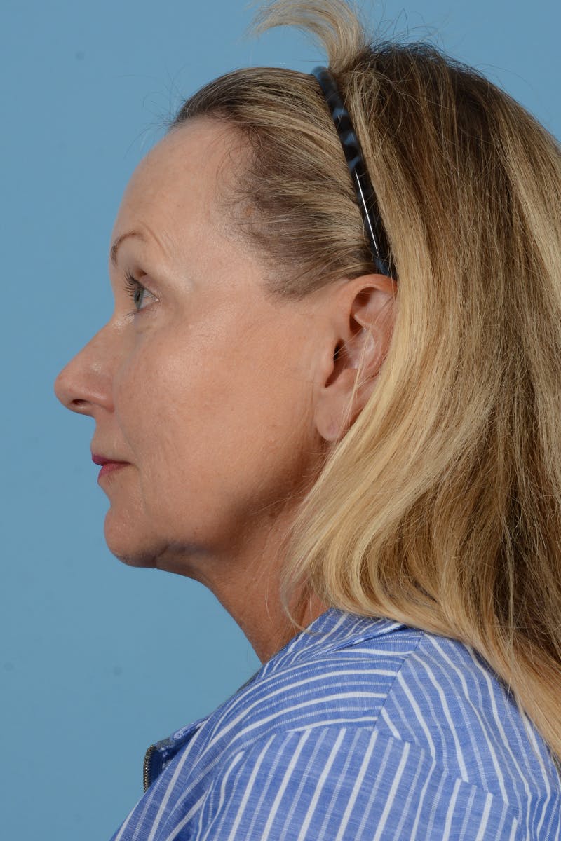 Facelift Before & After Gallery - Patient 210344 - Image 9