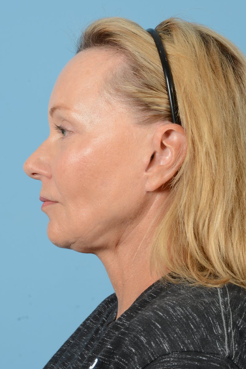 Facelift Before & After Gallery - Patient 210344 - Image 10