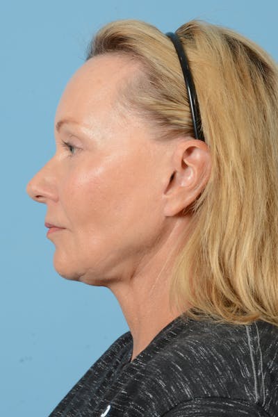 Facelift Before & After Gallery - Patient 210344 - Image 10
