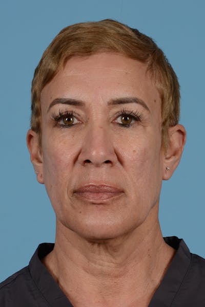 Facelift Before & After Gallery - Patient 351920 - Image 1