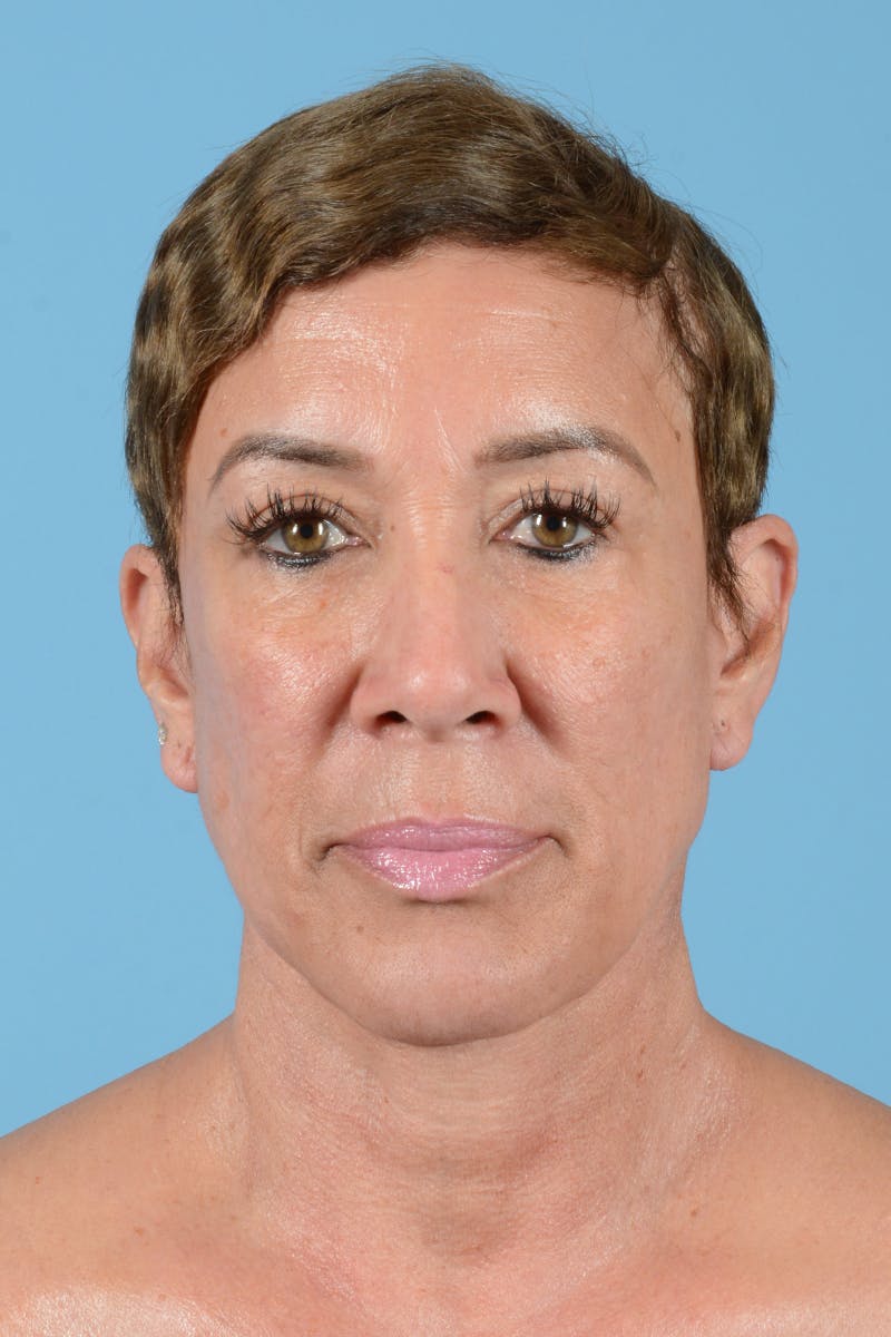 Facelift Before & After Gallery - Patient 351920 - Image 2