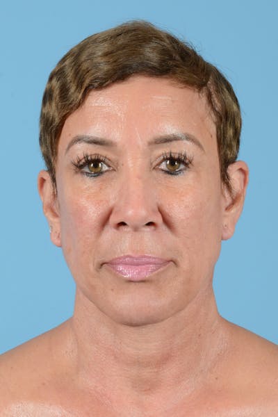 Facelift Before & After Gallery - Patient 351920 - Image 2
