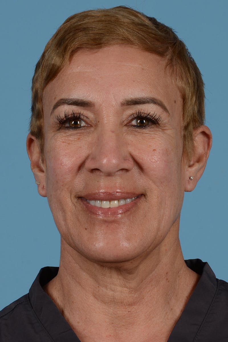 Facelift Before & After Gallery - Patient 351920 - Image 3