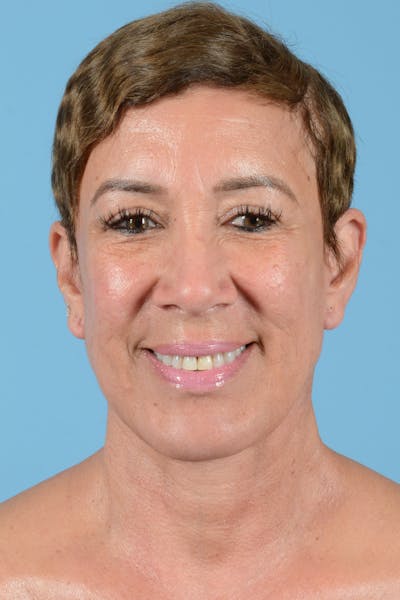 Facelift Before & After Gallery - Patient 351920 - Image 4