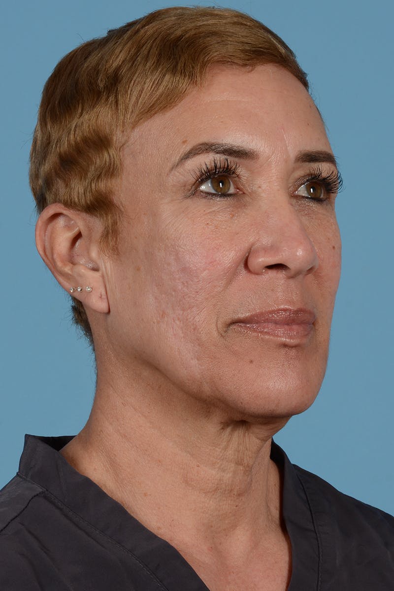 Facelift Before & After Gallery - Patient 351920 - Image 5