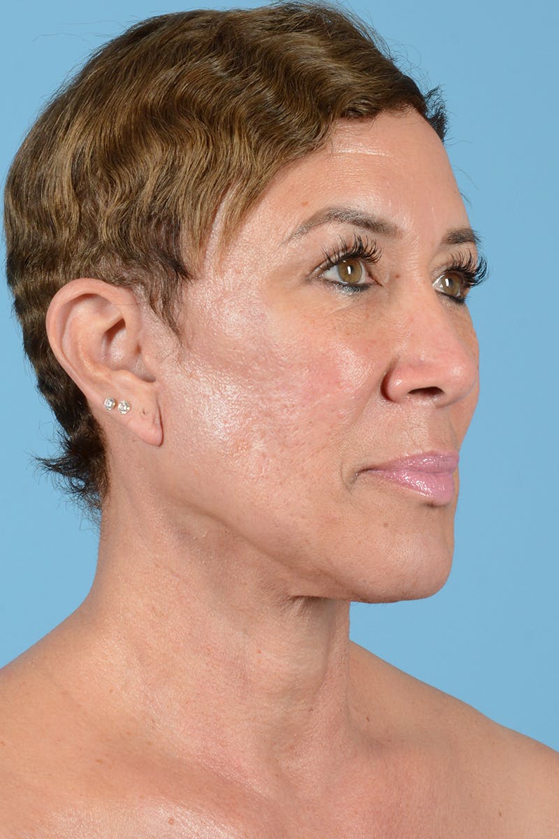 Facelift Before & After Gallery - Patient 351920 - Image 6