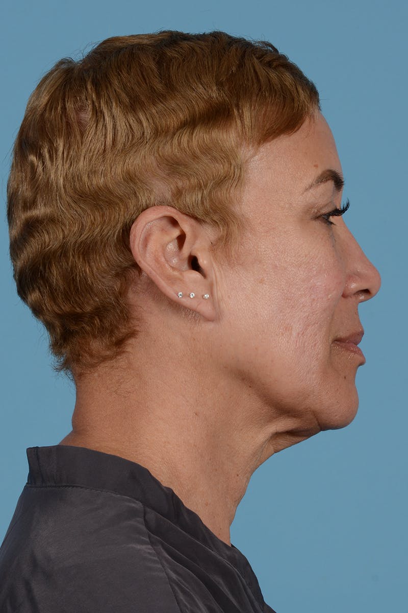 Facelift Before & After Gallery - Patient 351920 - Image 7