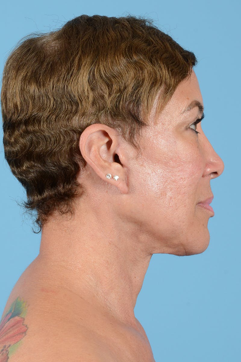 Facelift Before & After Gallery - Patient 351920 - Image 8