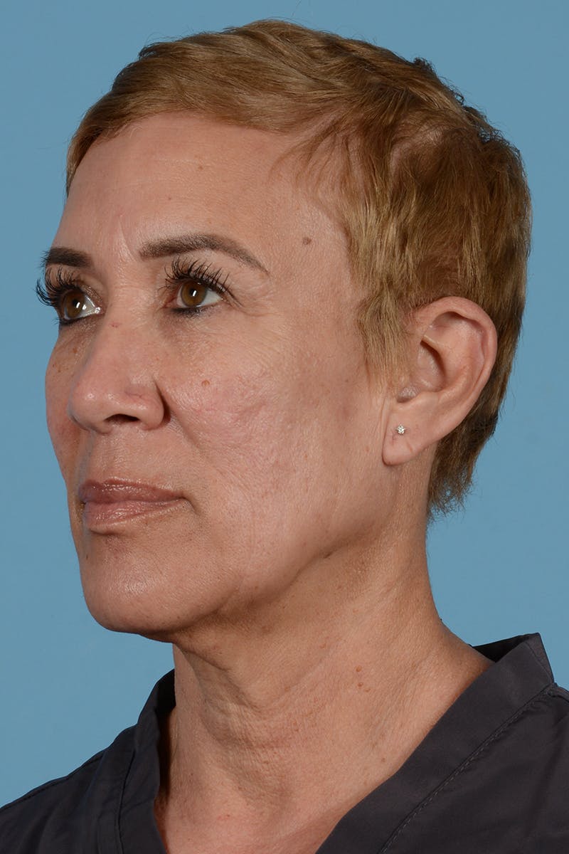 Facelift Before & After Gallery - Patient 351920 - Image 9
