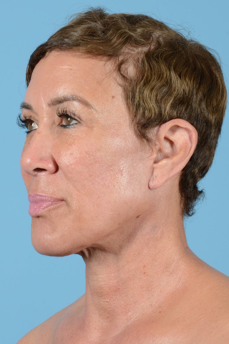 Facelift Before & After Gallery - Patient 351920 - Image 10