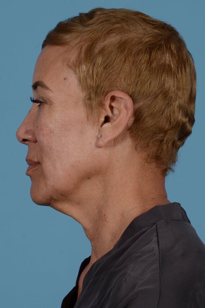Facelift Before & After Gallery - Patient 351920 - Image 11